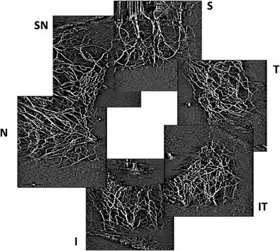 Anterior Segment Optical Coherence Tomography Angiography Following Trabecular Bypass Minimally Invasive Glaucoma Surgery